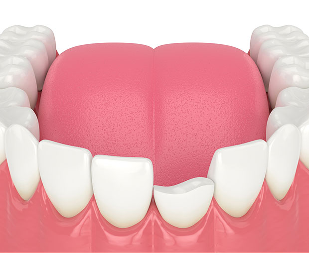 North Hills What Should I Do If I Chip My Tooth